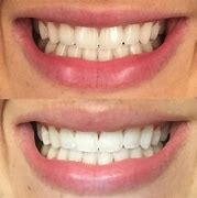 Image result for Teeth Cleaning and Whitening