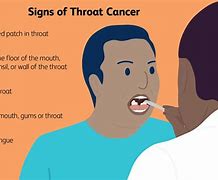 Image result for Throat Cancer From Smoking
