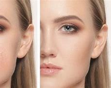 Image result for What Is Uneven Skin Tone