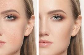 Image result for What Does Uneven Skin Tone Look Like