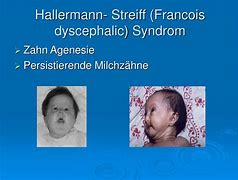 Image result for Kiefer Syndrome