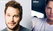 Image result for Chris Pratt Hair Transplant