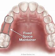 Image result for Space Maintenance and Retention Removable Orthodontic Appliances