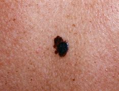 Image result for Melanoma Skin Cancer Types