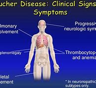 Image result for Gaucher Disease Treatment