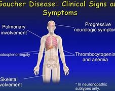 Image result for Gaucher Disease