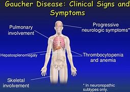 Image result for Gaucher Disease Type 1 Symptoms