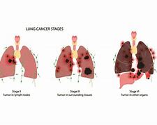 Image result for First Stage Lung Cancer