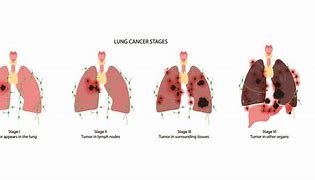 Image result for Stage 4B Lung Cancer