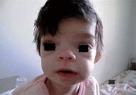 Image result for Photo About Apert Syndrome