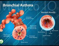 Image result for Asthma Attack Disease