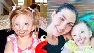 Image result for Pfeiffer Syndrome Death