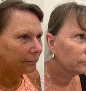 Image result for Skin Firming Cream Before and After