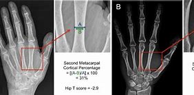 Image result for Osteoporosis X-ray vs Normal