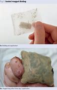 Image result for Maggots in Wounds On Human