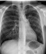 Image result for Carcinoid Tumor Lung Cancer