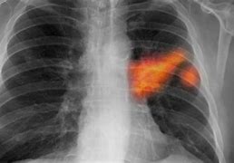 Image result for Stage 4 Metastatic Lung Cancer