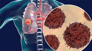 Image result for Stage 4 Lung Cancer Prognosis