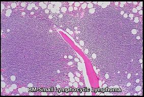Image result for Lymphoma Cancer