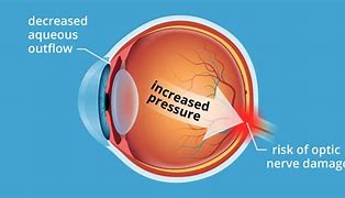 Image result for Eye Pressure