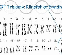 Image result for SVS Normal Karyotype Klinefelter Syndrome