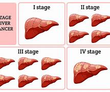 Image result for Liver Cancer
