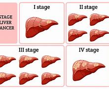 Image result for Cirrhosis of the Liver