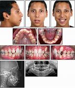 Image result for Marfan Syndrome Teeth