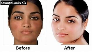 Image result for Permanent Skin Whitening Injection