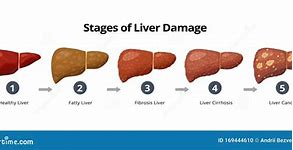 Image result for Stage 4 Liver Cancer
