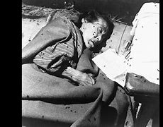 Image result for Atomic Bomb Injuries