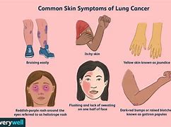 Image result for Lung Cancer Symptoms