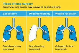 Image result for Stage 2 Lung Cancer