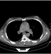 Image result for Gynecomastia Ultrasound Radiology