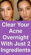 Image result for How to Clear Pimples Fast