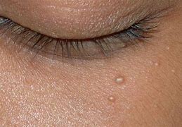 Image result for Small Skin Tags On Face