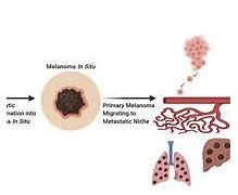 Image result for Stage IV Melanoma