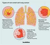 Image result for Non Small Cell Lung Cancer Types
