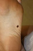 Image result for Skin Cancer Foot Pictures