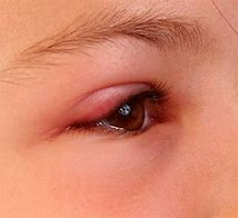 Image result for Swollen Eyelid Causes