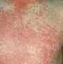 Image result for Early Signs of Scarlet Fever