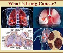 Image result for Lung Cancer Progression Stages