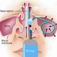 Image result for How Sinus Rinse Works