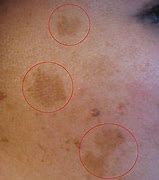 Image result for Blemish Skin Care