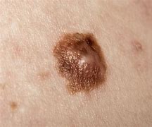 Image result for Age Spots vs Skin Cancer Early Stage Melanoma
