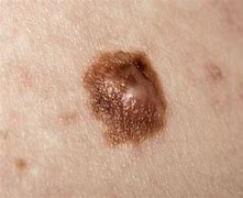 Image result for Pics of Stage 4 Melanoma