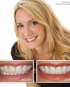 Image result for Veneers Before and After