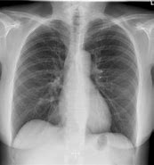 Image result for Normal Chest X-Ray