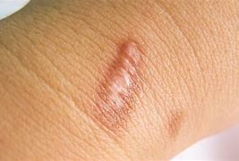 Image result for What Are Keloid Scars