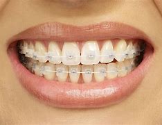 Image result for Clear or Metal Braces